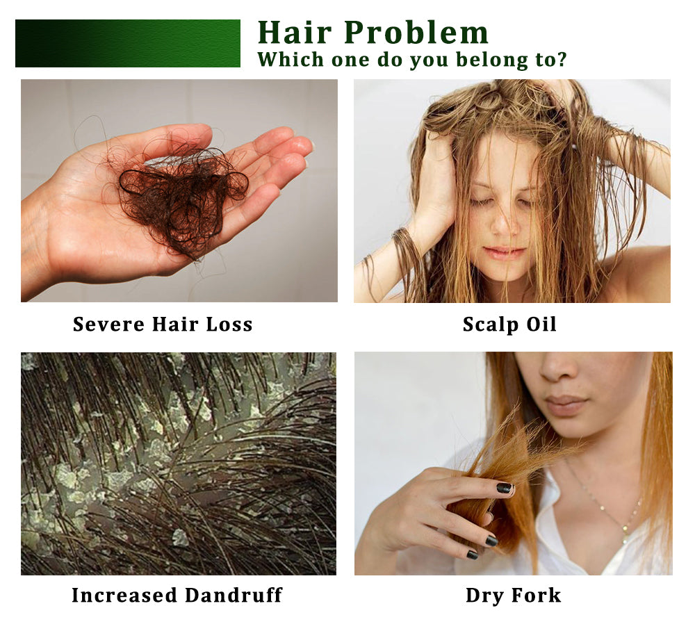 Problèmes de cheveux : perte de cheveux sévère, huile du cuir chevelu, pellicules et fourches sèches.